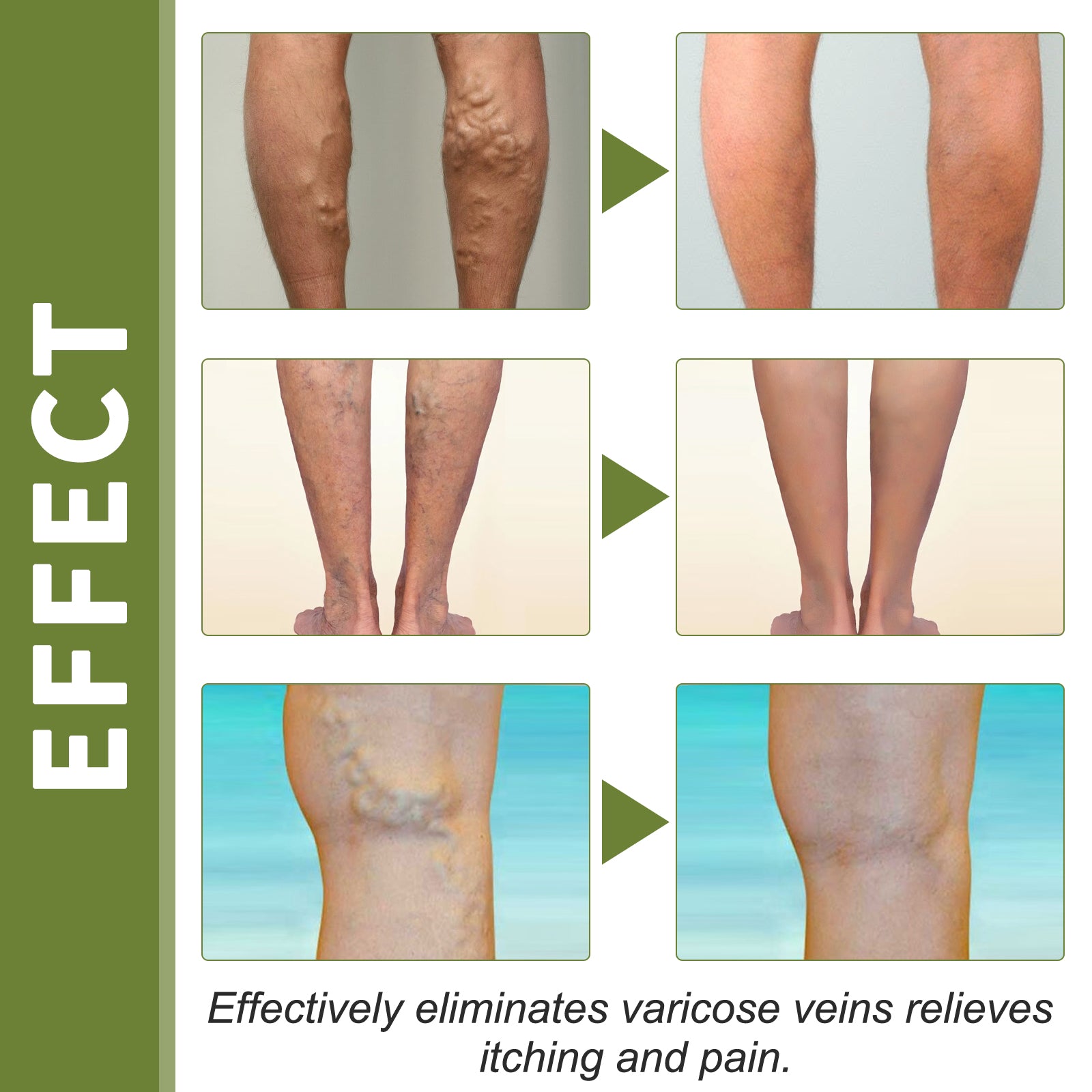 Vein Therapy Cream Soothe Sore Swollen Leg Blood Vessels Repair Veins Body Care Cream